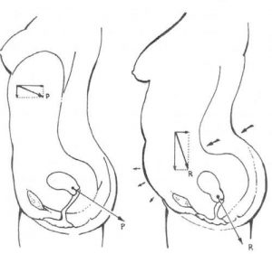 RELACION SUELO PELVICO DIASTASIS ABDOMINAL